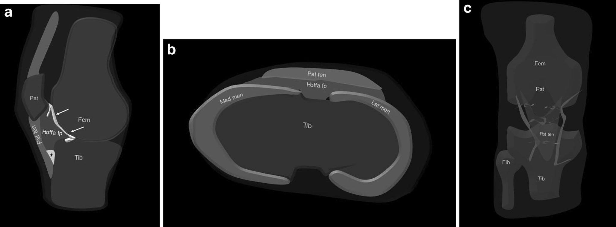 Hoffa 脂肪墊與前膝痛：從水腫分布到病因的 MRI 判讀文章縮圖