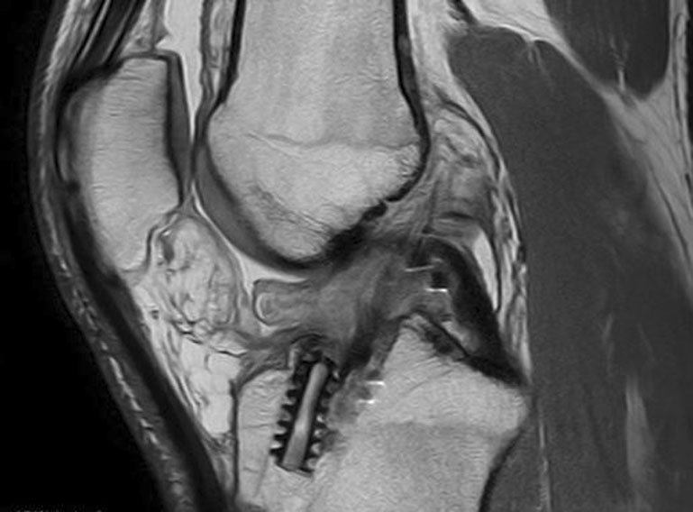ACL 重建後 Cyclops lesion — Original Fig. 10