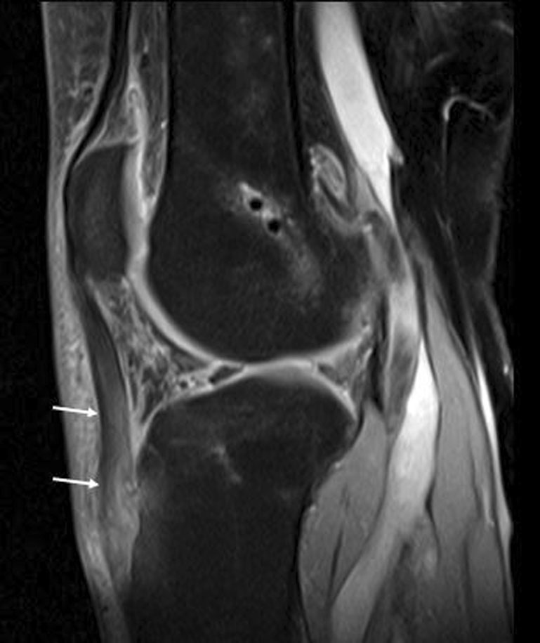 取腱後髕腱病變 — Original Fig. 14