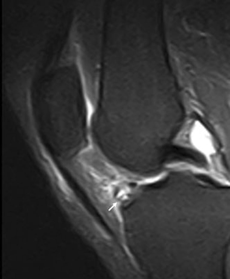 HFP 內多房性 ganglion — Original Fig. 19