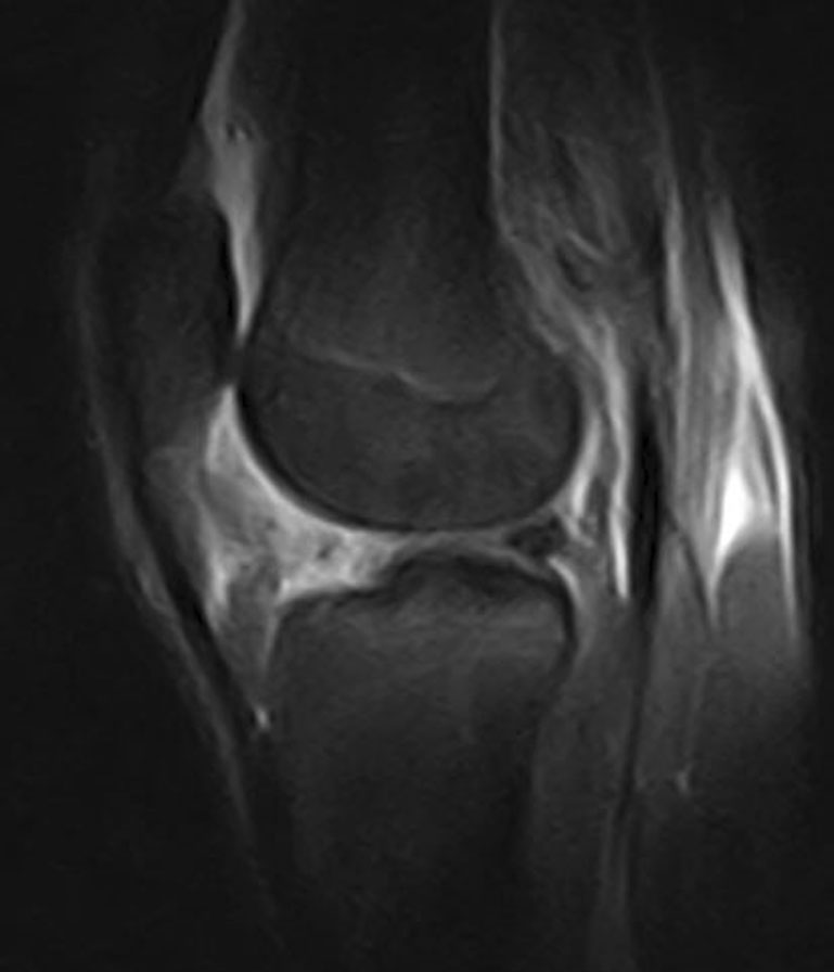 反覆微小創傷與 Hoffa’s disease — Original Fig. 8