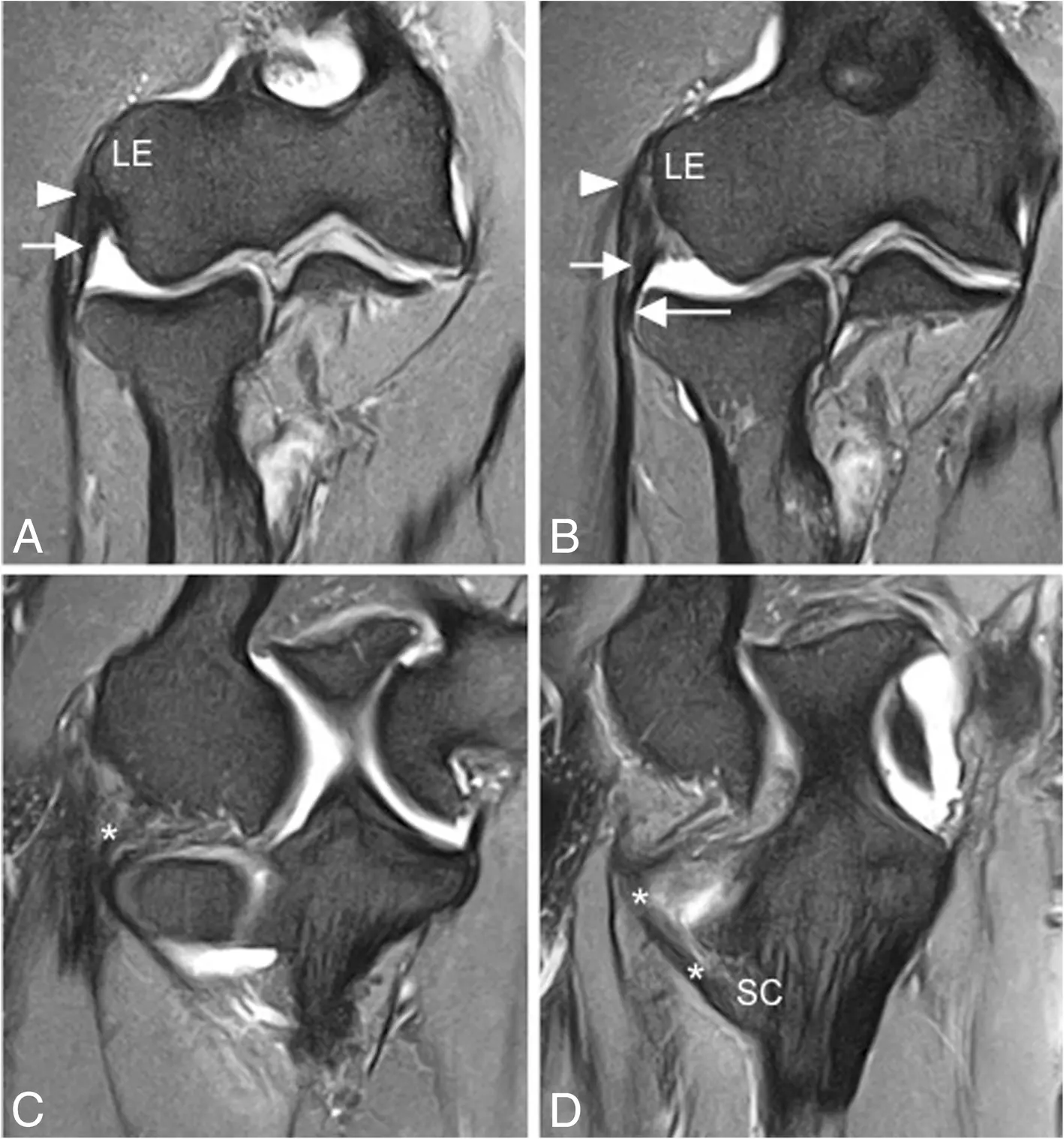 正常外側肘部解剖的連續冠狀位脂肪抑制質子密度加權 MRI