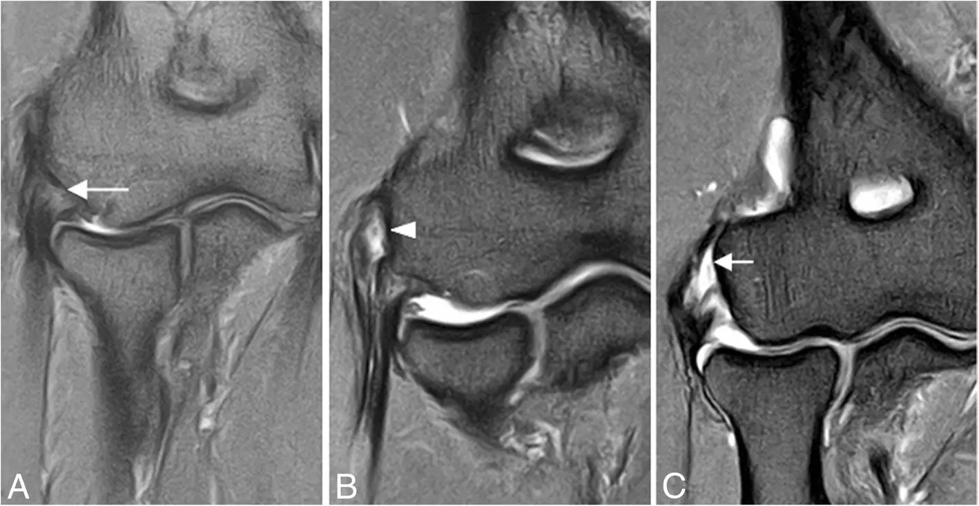外側肘痛磁振造影（MRI）影像學習：別漏掉外側肘不穩定文章縮圖