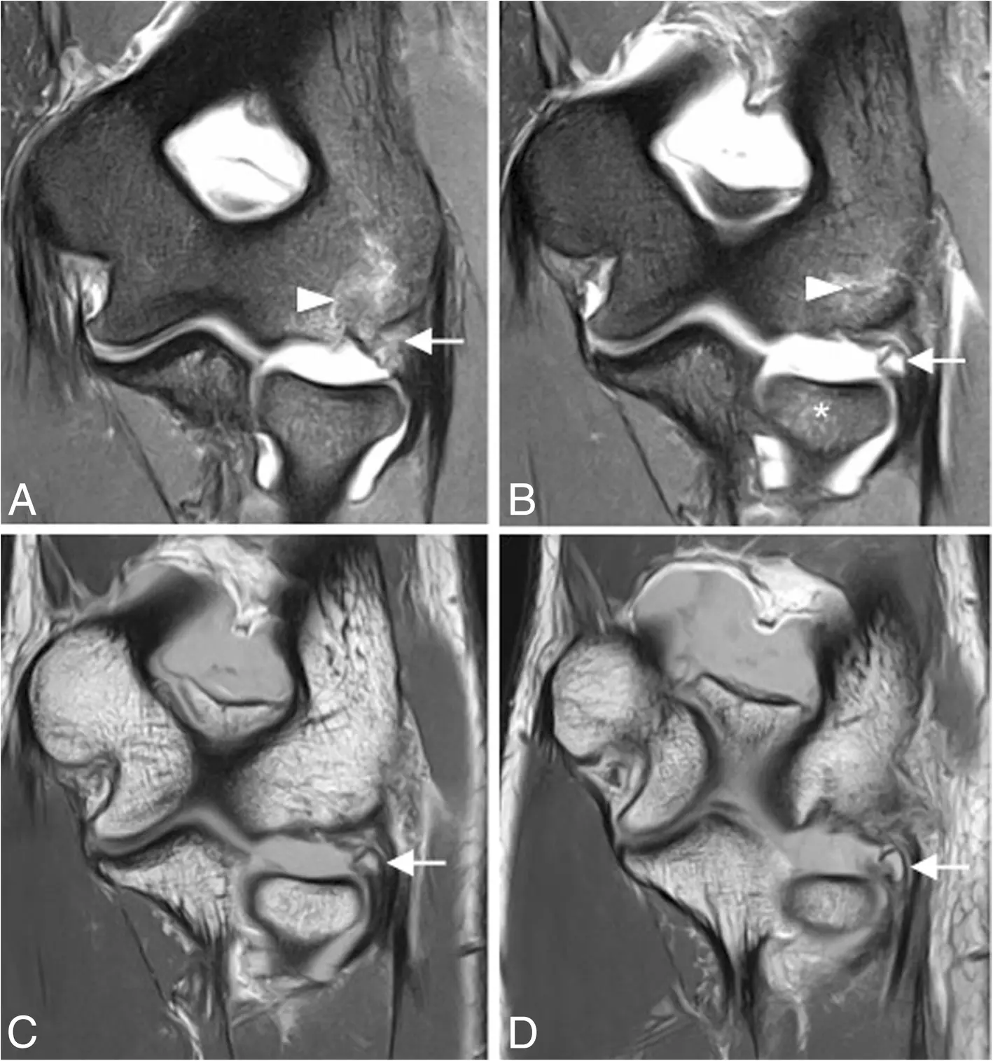 第一期後外側旋轉不穩定合併近端 LUCL 撕脫的 MRI