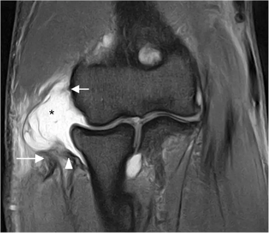 第二期後外側旋轉不穩定合併 CET、RCL 與 LUCL 撕脫的 MRI