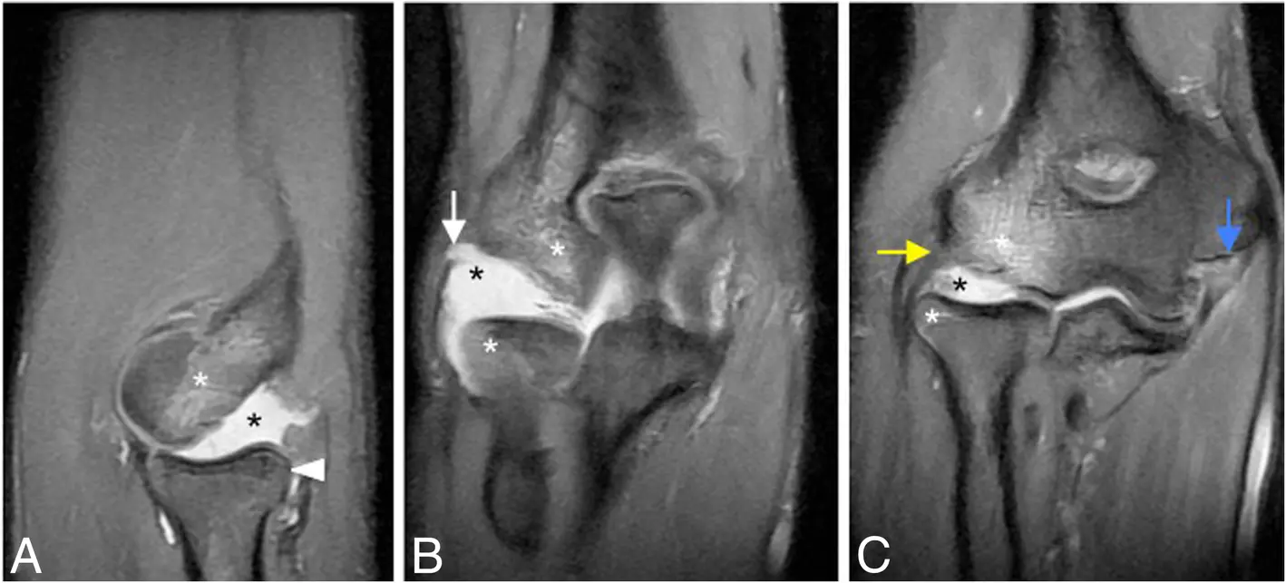 第三 B 期後外側旋轉不穩定合併肱橈關節半脫位的 MRI