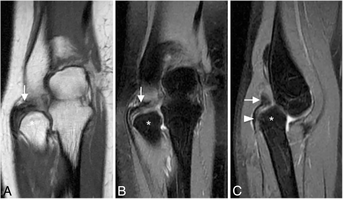 慢性環狀韌帶撕裂、移位與橈骨頭脫出的 MRI