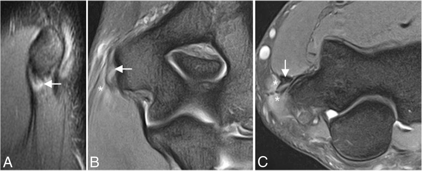 內側肘痛磁振造影（MRI）影像學習：從高爾夫球肘到外翻不穩定文章縮圖